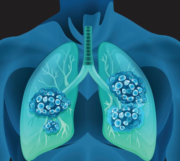 CMS expands Medicare coverage for lung cancer screening – MedCity News